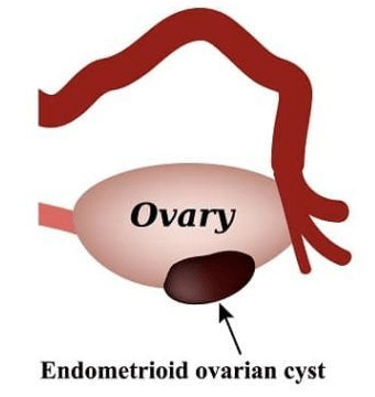 endometrioid-ovarian-cyst
