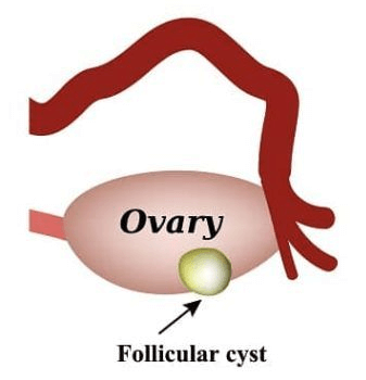 follicular-cyst